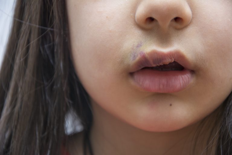 close-up de menina com lábios inchado referência a fissura labio platina