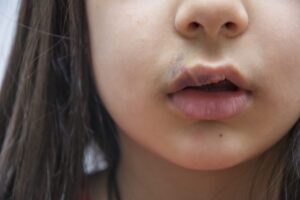 Comissão debate políticas públicas de atenção integral às pessoas com fissura labiopalatina