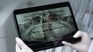 Saliva artificial ajuda a proteger os dentes de pacientes com câncer de cabeça e pescoço, revela estudo