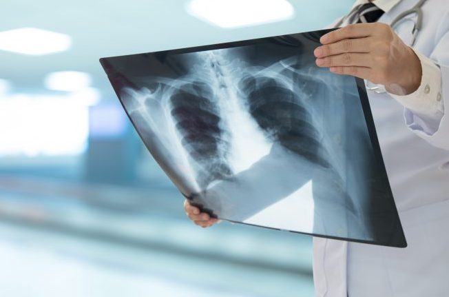 Comissão de Saúde debate incorporação da terapia tripla para tratamento da fibrose cística